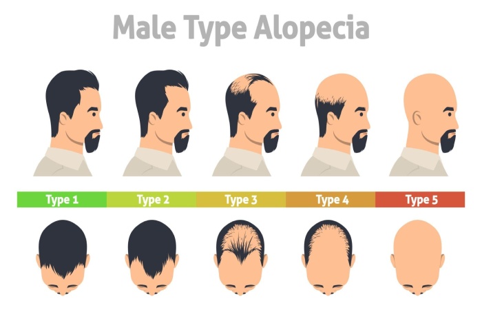 There are Several Types of Hair Loss, Also Called Alopecia