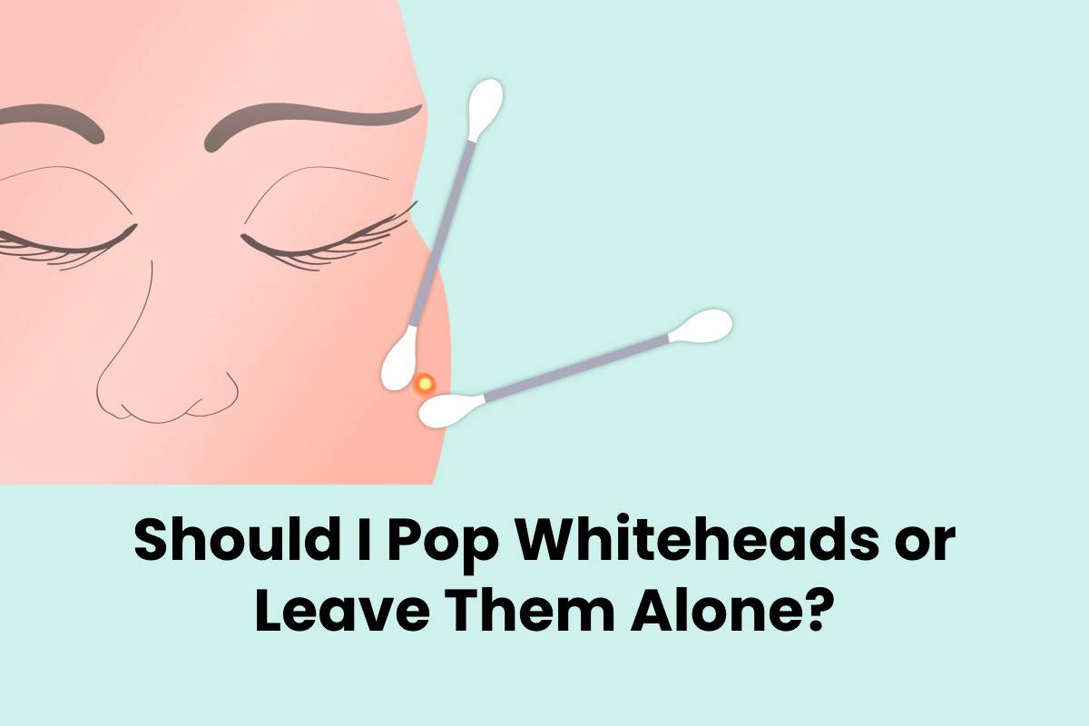 Should I Pop Whiteheads or Leave Them Alone? SBH