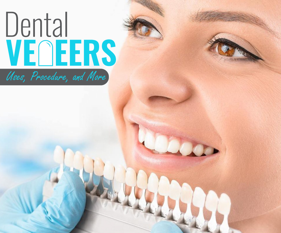 Dental Veneers Uses, Procedure, and More
