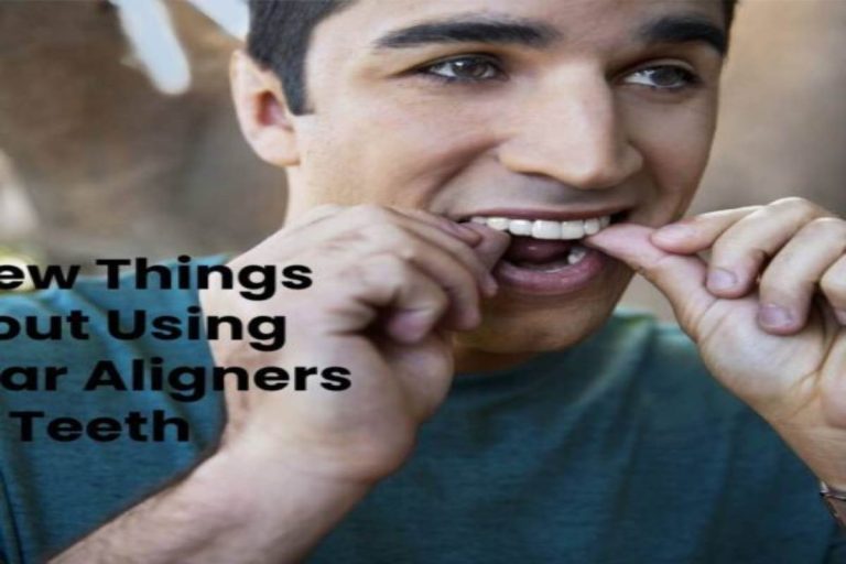 A Few Things About Using Clear Aligners For Teeth