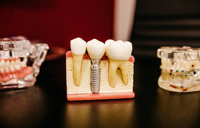 Dental Implants Write For Us