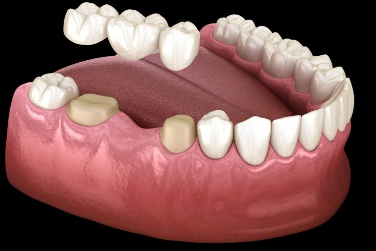 Dental Bridges: What You Need to Know