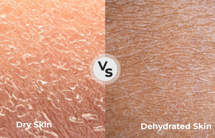 dry vs dehydrated skin comparison