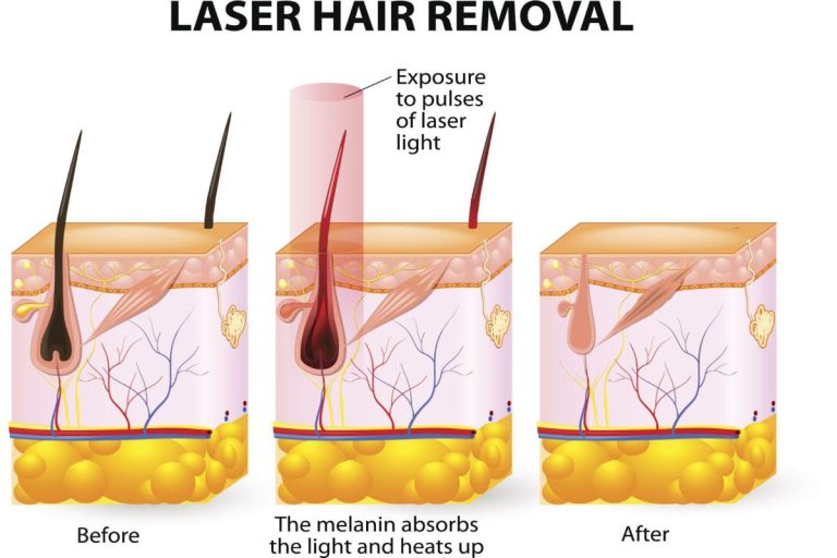 Laser Hair Removal Cost and Results: Everything You Need to Know
