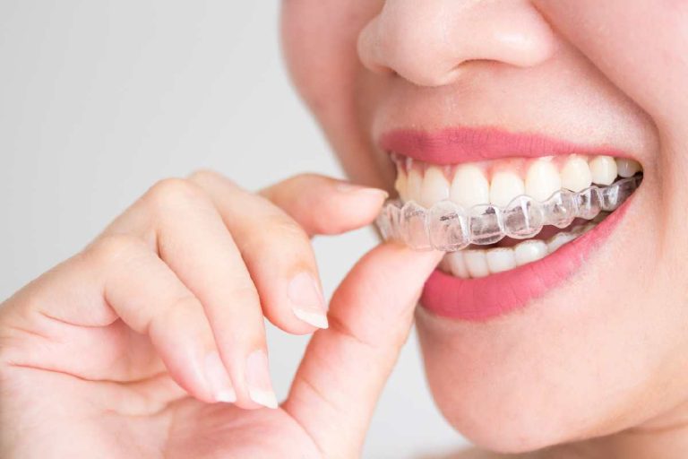 Invisalign Singapore: The Clear Way to Straighten Your Teeth